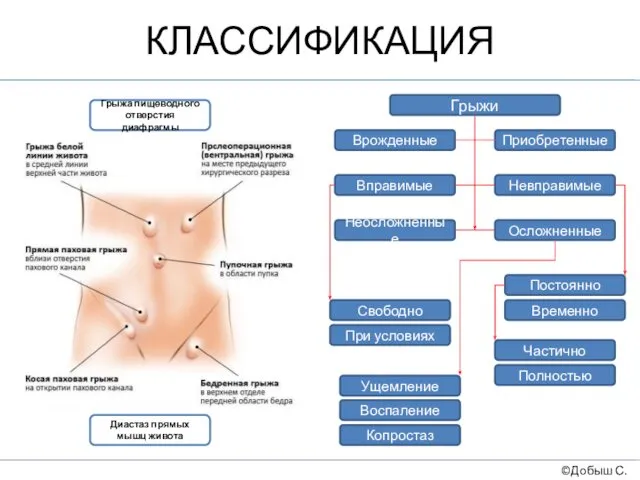 КЛАССИФИКАЦИЯ ©Добыш С.А. Грыжи Врожденные Приобретенные Вправимые Невправимые Неосложненные Осложненные Свободно