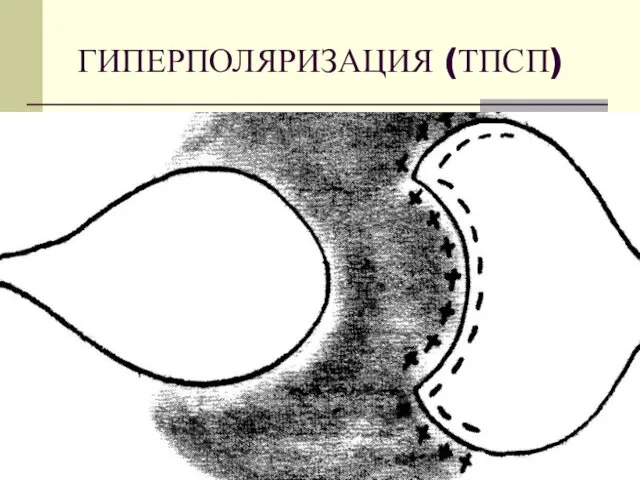 ГИПЕРПОЛЯРИЗАЦИЯ (ТПСП)