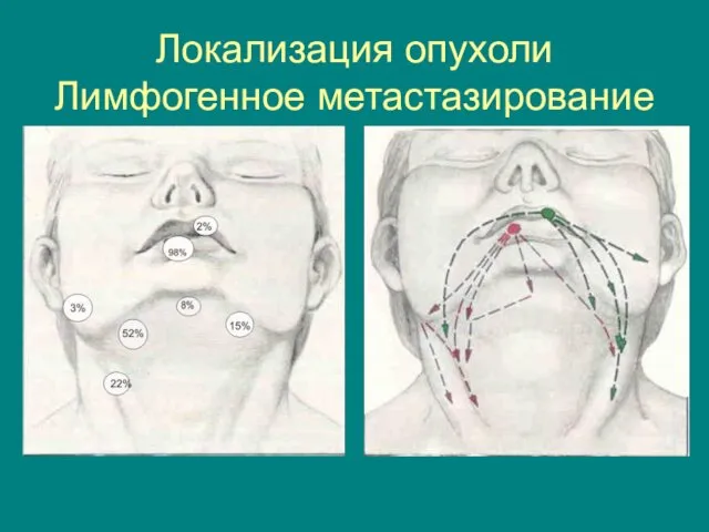 Локализация опухоли Лимфогенное метастазирование