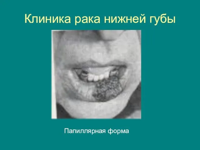 Клиника рака нижней губы Папиллярная форма