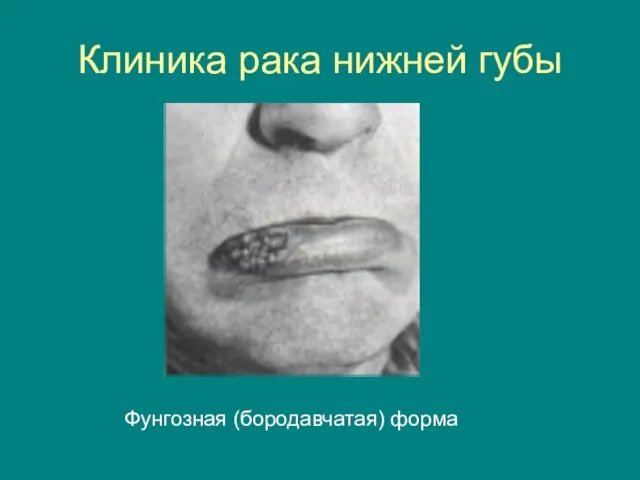 Клиника рака нижней губы Фунгозная (бородавчатая) форма