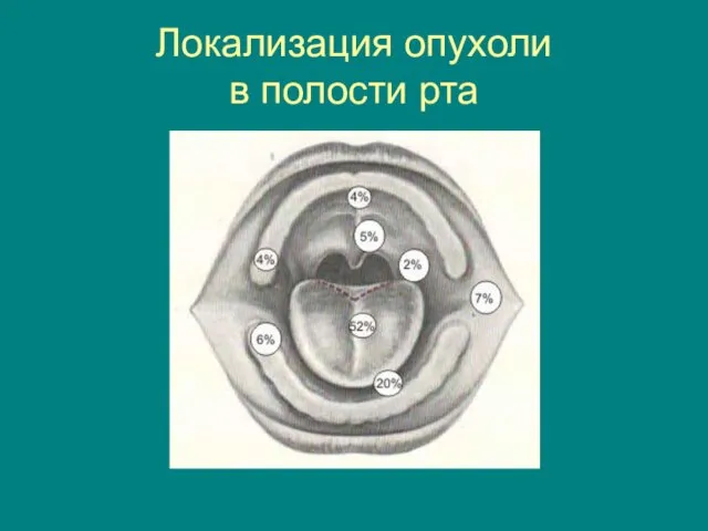 Локализация опухоли в полости рта