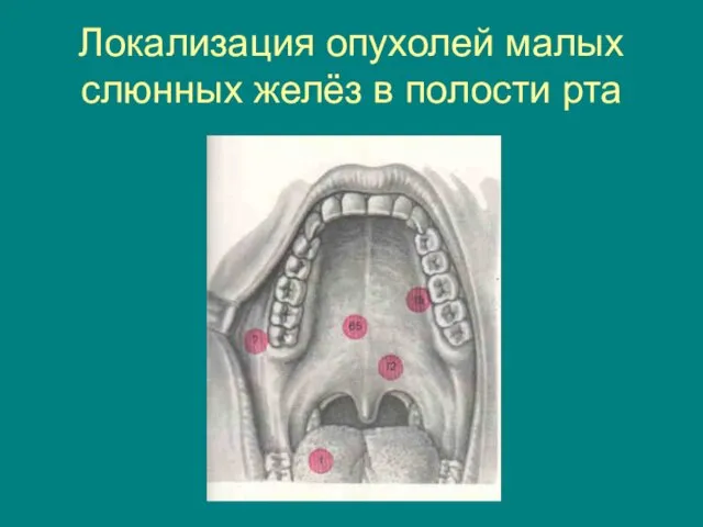 Локализация опухолей малых слюнных желёз в полости рта