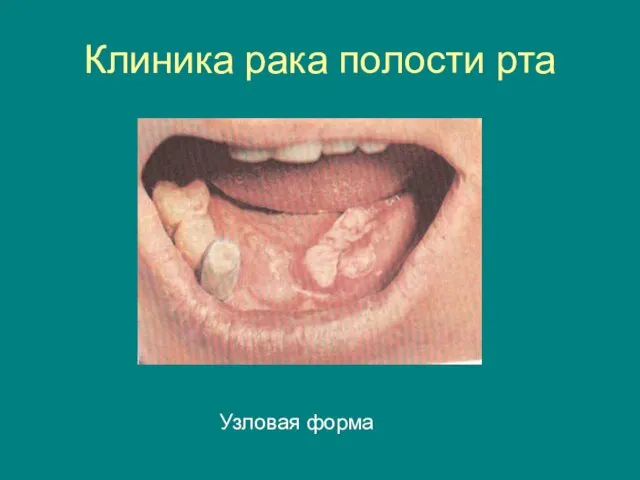 Клиника рака полости рта Узловая форма