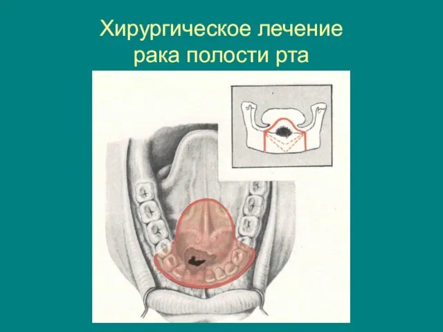 Хирургическое лечение рака полости рта