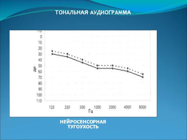 ТОНАЛЬНАЯ АУДИОГРАММА НЕЙРОСЕНСОРНАЯ ТУГОУХОСТЬ