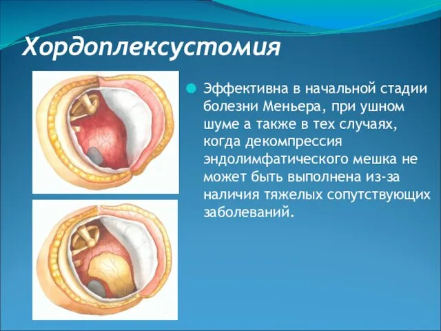 Хордоплексустомия Эффективна в начальной стадии болезни Меньера, при ушном шуме а
