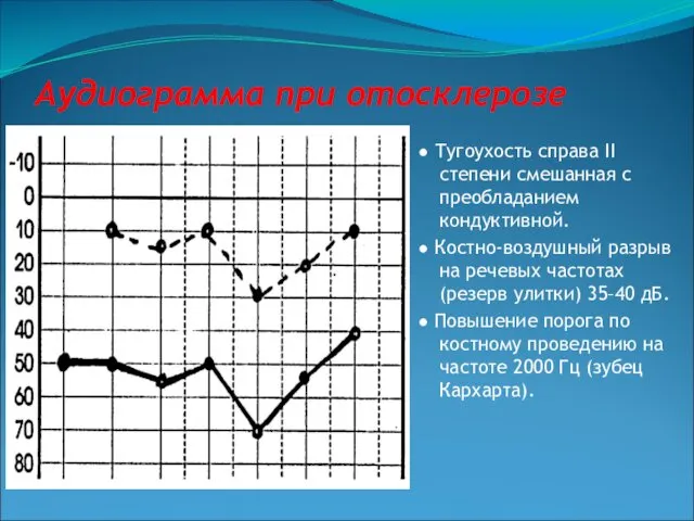 Аудиограмма при отосклерозе ● Тугоухость справа II степени смешанная с преобладанием