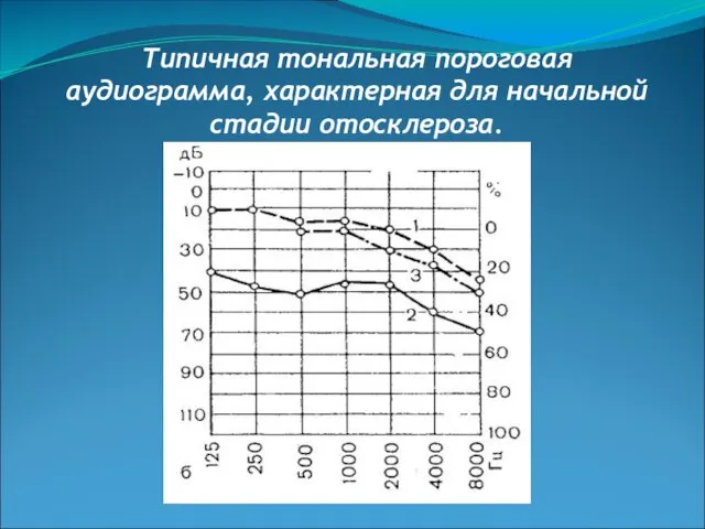 Типичная тональная пороговая аудиограмма, характерная для начальной стадии отосклероза.