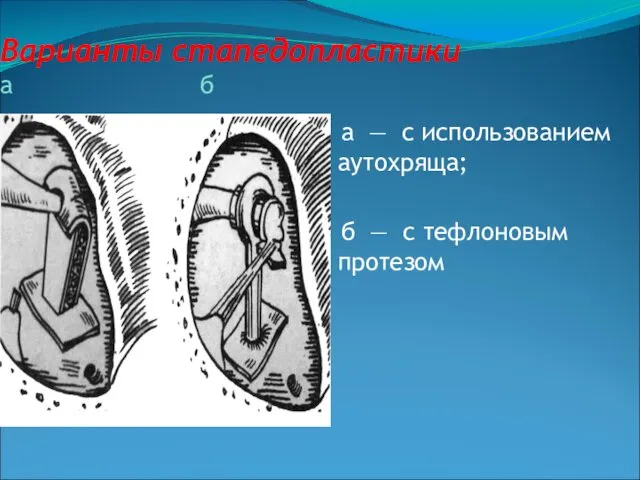 Варианты стапедопластики а б а — с использованием аутохряща; б — с тефлоновым протезом