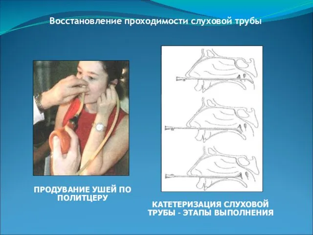 Восстановление проходимости слуховой трубы ПРОДУВАНИЕ УШЕЙ ПО ПОЛИТЦЕРУ КАТЕТЕРИЗАЦИЯ СЛУХОВОЙ ТРУБЫ – ЭТАПЫ ВЫПОЛНЕНИЯ