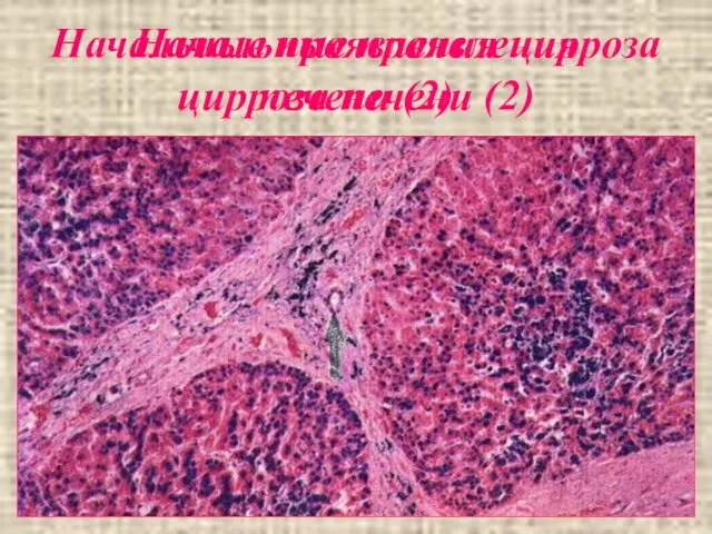 Начальные проявления цирроза печени (2) Начальные проявления цирроза печени (2)