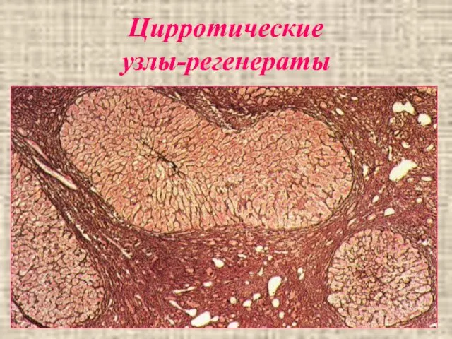 Цирротические узлы-регенераты Цирротические узлы-регенераты