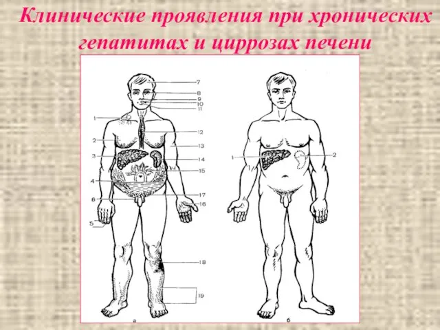 Клинические проявления при хронических гепатитах и циррозах печени