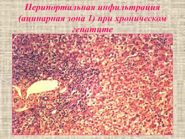 Перипортальная инфильтрация (ацинарная зона 1) при хроническом гепатите