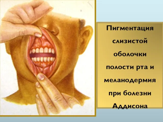 Пигментация слизистой оболочки полости рта и меланодермия при болезни Аддисона