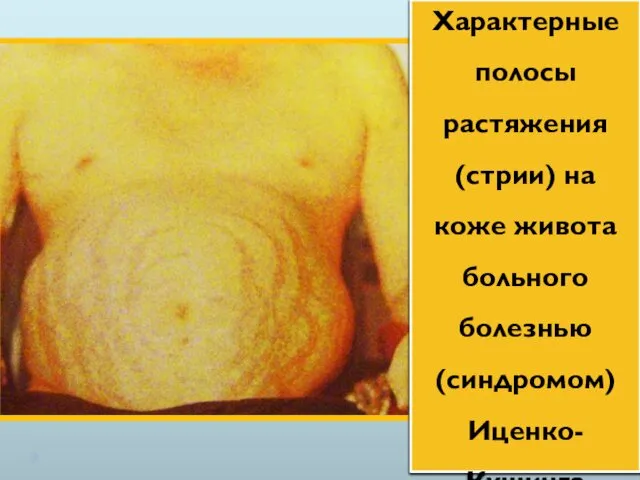 Характерные полосы растяжения (стрии) на коже живота больного болезнью (синдромом) Иценко-Кушинга