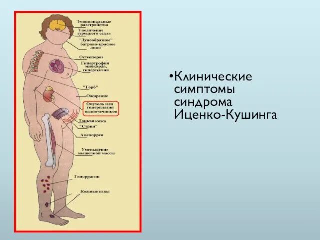 Клинические симптомы синдрома Иценко-Кушинга