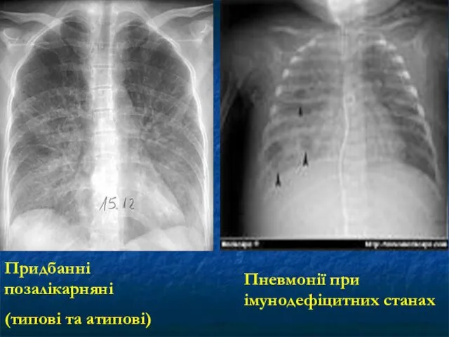 Пневмонії при імунодефіцитних станах Придбанні позалікарняні (типові та атипові)