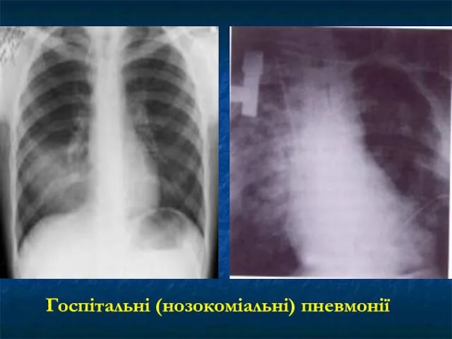 Госпітальні (нозокоміальні) пневмонії