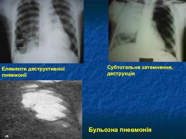 Елементи деструктивної пневмонії Субтотальне затемнення, деструкція Бульозна пневмонія