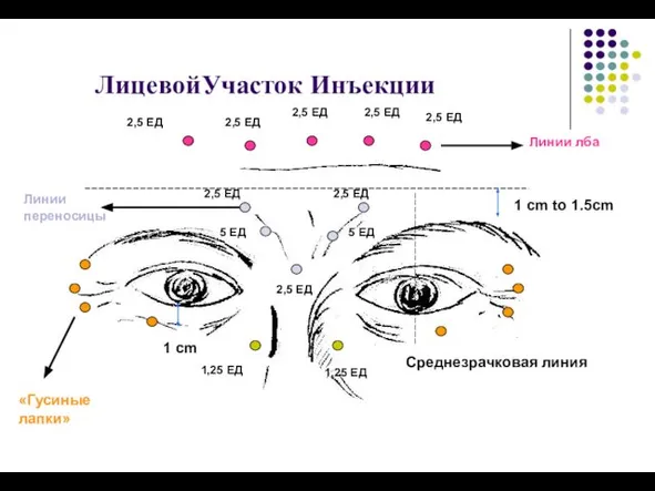 ЛицевойУчасток Инъекции 1 cm to 1.5cm 1 cm Среднезрачковая линия Линии