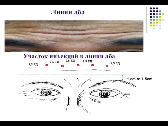 Линии лба Участок инъекций в линии лба 2,5 ЕД 2,5 ЕД