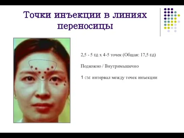 Точки инъекции в линиях переносицы 2,5 - 5 ЕД x 4-5