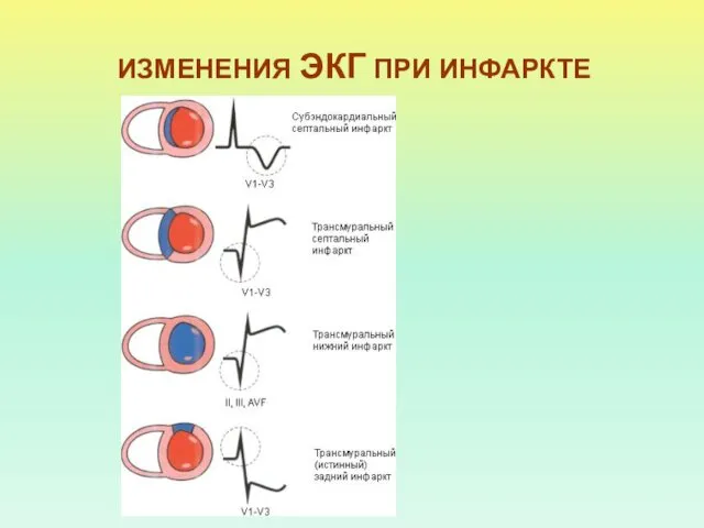 ИЗМЕНЕНИЯ ЭКГ ПРИ ИНФАРКТЕ