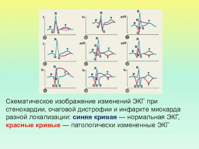 Схематическое изображение изменений ЭКГ при стенокардии, очаговой дистрофии и инфаркте миокарда