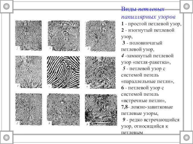 Виды петлевых папиллярных узоров 1 - простой петлевой узор, 2 -