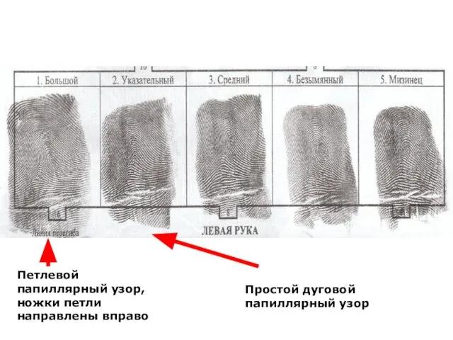 Петлевой папиллярный узор, ножки петли направлены вправо Простой дуговой папиллярный узор