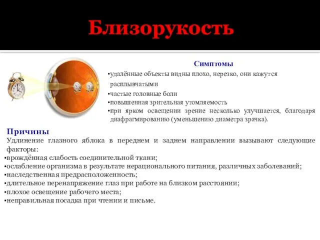 Близорукость Симптомы удалённые объекты видны плохо, нерезко, они кажутся расплывчатыми частые