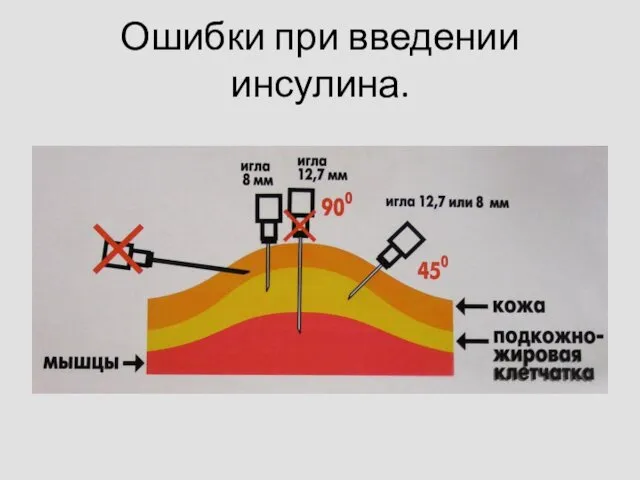 Ошибки при введении инсулина.