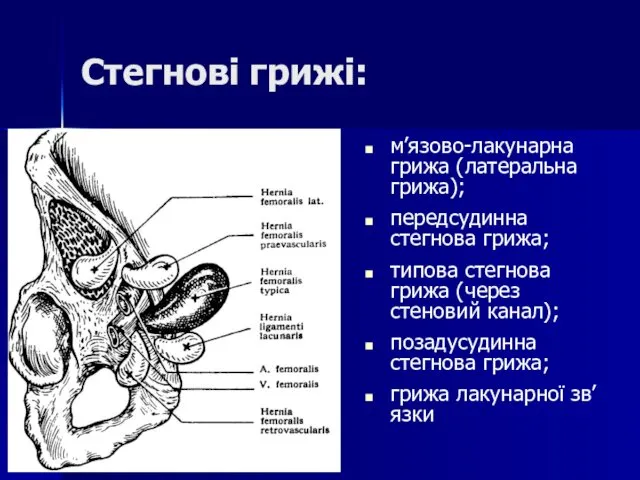 Стегнові грижі: м’язово-лакунарна грижа (латеральна грижа); передсудинна стегнова грижа; типова стегнова