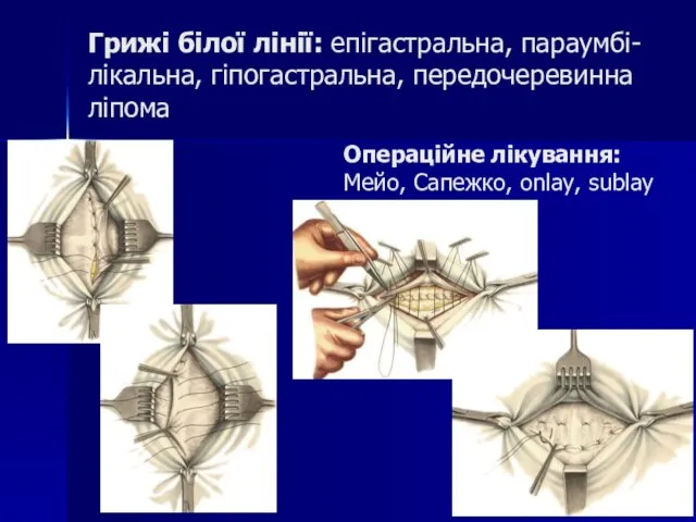 Грижі білої лінії: епігастральна, параумбі-лікальна, гіпогастральна, передочеревинна ліпома Операційне лікування: Мейо, Сапежко, onlay, sublay