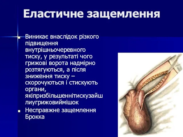 Еластичне защемлення Виникає внаслідок різкого підвищення внутрішньочеревного тиску, у результаті чого