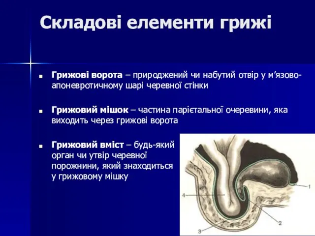 Складові елементи грижі Грижові ворота – природжений чи набутий отвір у