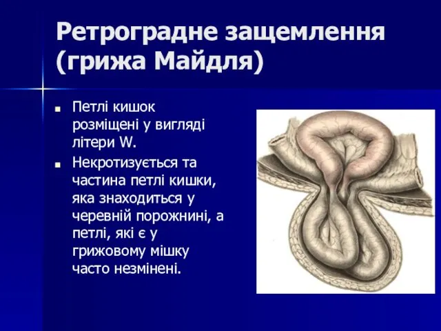 Ретроградне защемлення (грижа Майдля) Петлі кишок розміщені у вигляді літери W.