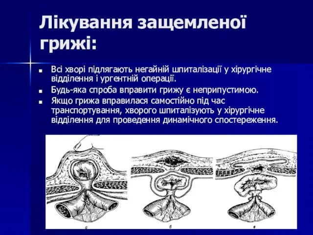 Лікування защемленої грижі: Всі хворі підлягають негайній шпиталізації у хірургічне відділення