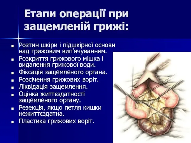 Етапи операції при защемленій грижі: Розтин шкіри і підшкірної основи над