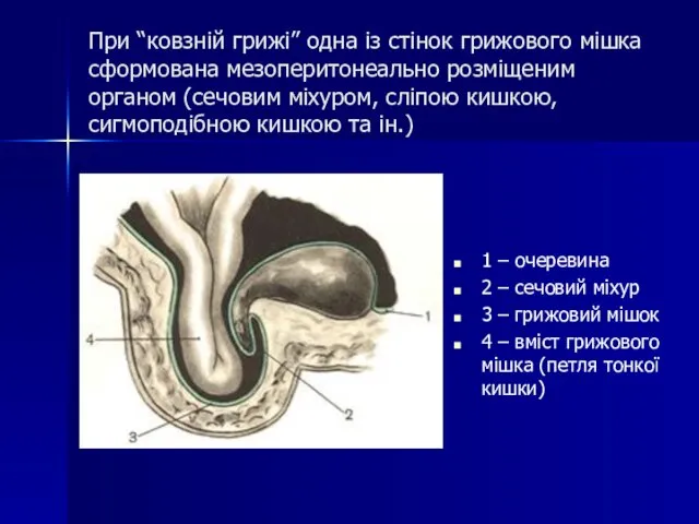 При “ковзній грижі” одна із стінок грижового мішка сформована мезоперитонеально розміщеним