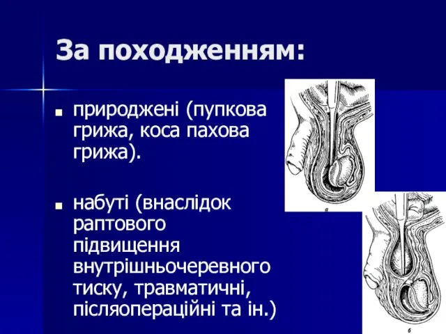 За походженням: природжені (пупкова грижа, коса пахова грижа). набуті (внаслідок раптового