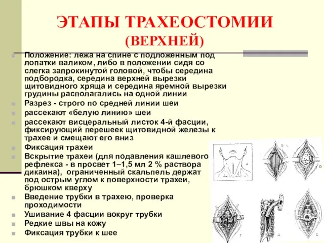 ЭТАПЫ ТРАХЕОСТОМИИ (ВЕРХНЕЙ) Положение: лежа на спине с подложенным под лопатки