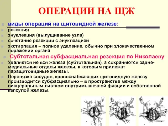 ОПЕРАЦИИ НА ЩЖ виды операций на щитовидной железе: резекция энуклеация (вылущивание