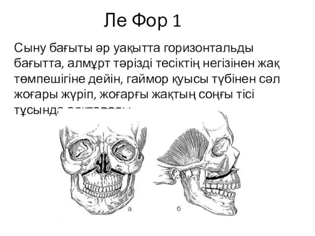 Ле Фор 1 Сыну бағыты әр уақытта горизонтальды бағытта, алмұрт тәрізді