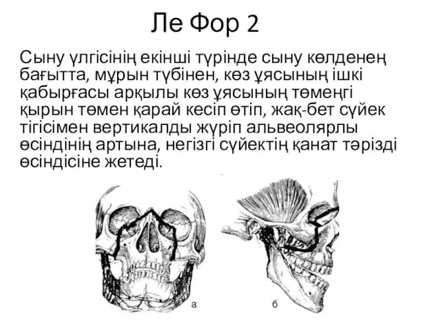 Ле Фор 2 Сыну үлгісінің екінші түрінде сыну көлденең бағытта, мұрын