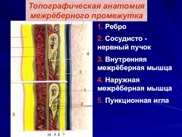 Топографическая анатомия межрёберного промежутка 1. Ребро 2. Сосудисто - нервный пучок