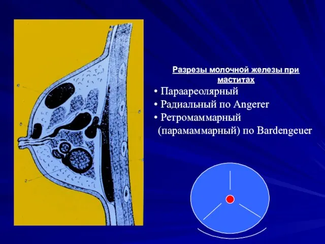 Разрезы молочной железы при маститах Параареолярный Радиальный по Angerer Ретромаммарный (парамаммарный) по Bardengeuer