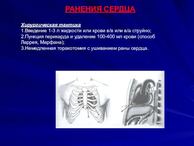 Пункция перикарда Хирургическая тактика 1.Введение 1-3 л жидкости или крови в/в